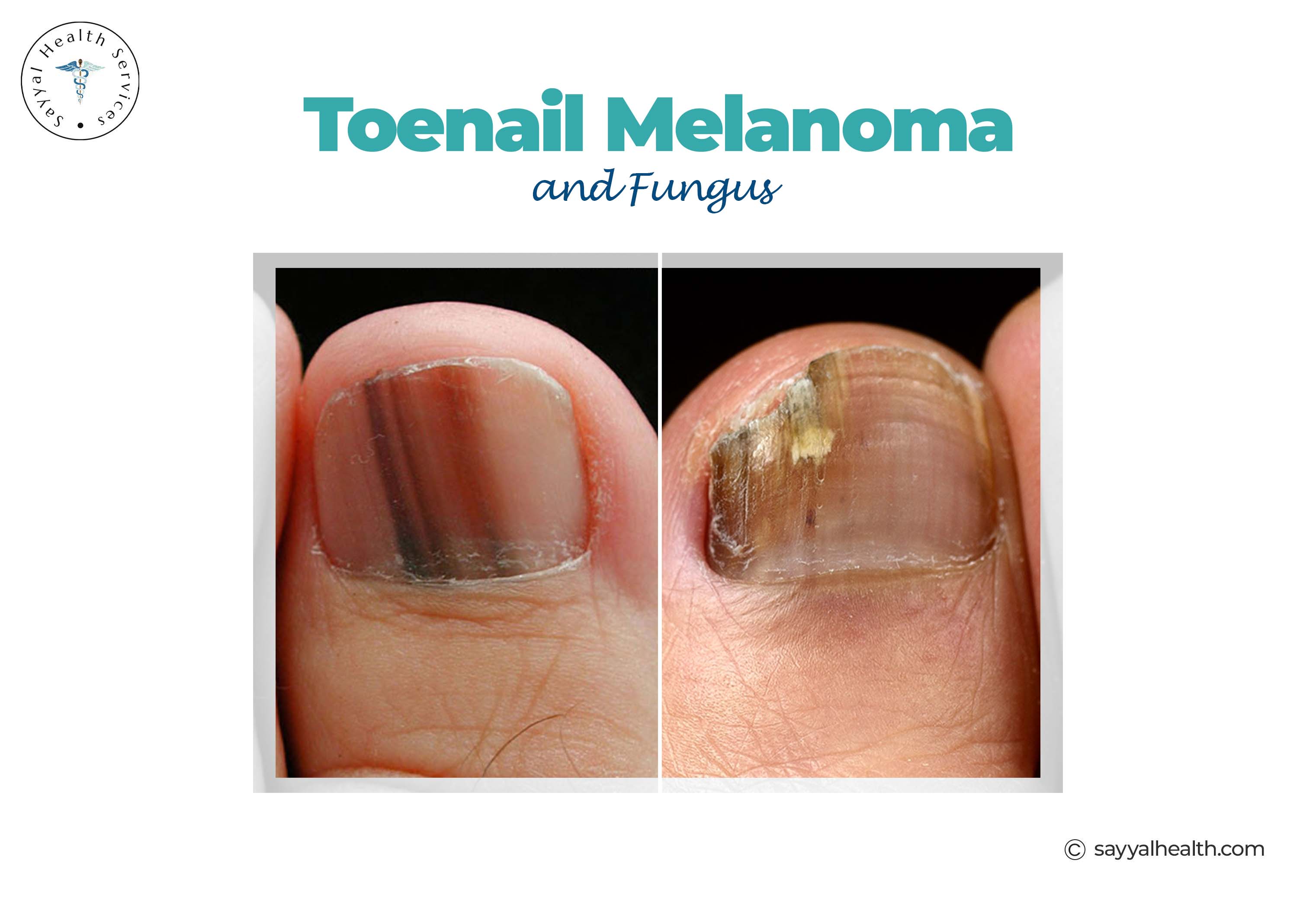 Toenail melanoma versus fungal infection showing dark streaks and discoloration